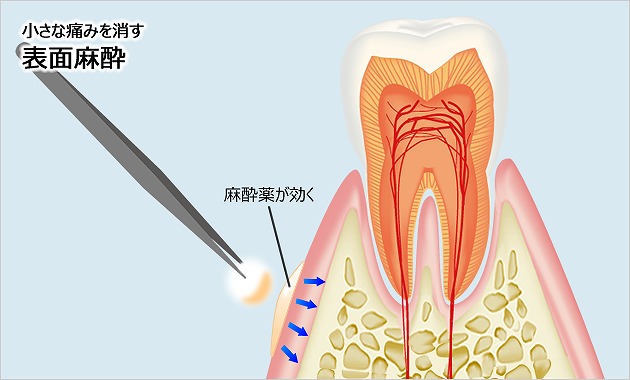 注射針がチクっとするのを緩和する「表面麻酔」