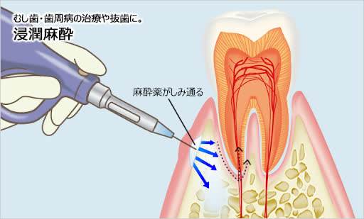 麻酔の痛みを軽減する「電動麻酔器」