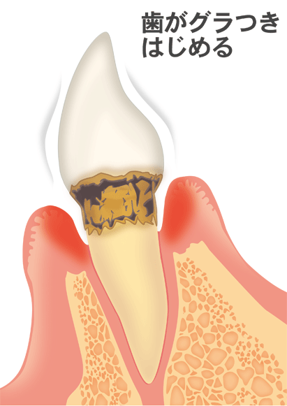 歯周炎（中度）
