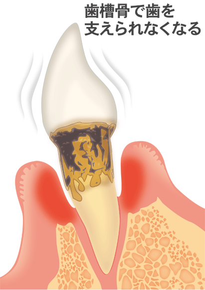 歯周炎（重度）