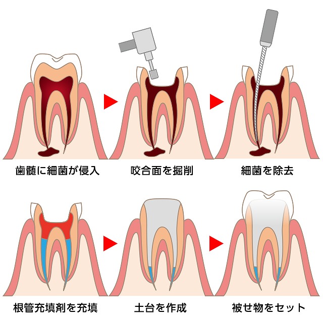 抜歯を回避できる可能性がある「根管治療」